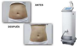 Todas tus preguntas y las respuestas que necesitas en el tratamiento de la grasa localizada, sin cirugía y de forma permanente, están en Focus Shape Pro de Grupo Slyou. Tratamientos rápidos, cómodos y clínicamente probados