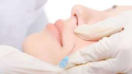 Clínica Millán&Vila-Rovira presenta, de cara a la primavera, Hidra-lux. Tratamiento para la máxima hidratación y luminosidad del rostro mediante peeling de bioestimulación tópica e infiltraciones de ácido hialurónico no reticulado