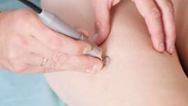 La fotoesclerosis y el láser Nd:YAG para las varices, y los láseres PDL o KTP para las arañas vasculares, consiguen acabar con estos problemas en pocas sesiones y sin interrumpir la rutina diaria de los pacientes