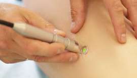 El láser de alta frecuencia se convierte en un método recurrido y efectivo para el tratamiento fácil y seguro a la hora de eliminar las antiestéticas arañas vasculares. Nos lo cuenta con todo detalle la Dra. Ana María Téllez