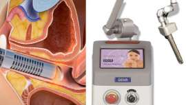 El láser ginecológico se convierte en el gran aliado de muchos de los efectos que la menopausia tiene en la mujer, así como en algunos efectos secundarios de los tratamientos de quimio y radioterapia