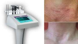 Dispor da tecnologia que nos permita curar rapidamente ruturas da pele, cicatrizes, estrias, acne, etc., sem deixar rasto, é um seguro de beleza que nos presenteia com clientes satisfeitos. Assim trabalha Binary Care