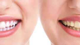 Para un blanqueamiento óptimo hay que seleccionar bien el cromatismo de
los dientes y recordar que es un tratamiento destinado a devolver a una o varias piezas dentales su color y translucidez originales