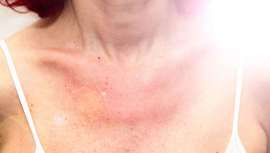 Su nombre científico es erupción polimórfica lumínica y hace que estar a la sombra se convierta en obligado los días de sol. La dermatología lo identifica, pone freno y previene y así facilita poder disfrutar al máximo de las jornadas de verano