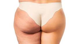 El transtorno afecta al 16% de las mujeres y, al margen del componente estético, puede desencadenar en una invalidez con el tiempo