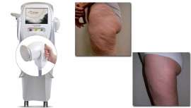 Plataforma de Alma Láser, Accent Prime es elegida por la mayoría de especialistas para tratamientos faciales y corporales. El doctor Alberto Casado, director Médico de Clínicas Comyce, nos enumera una a una todas sus ventajas y resultados