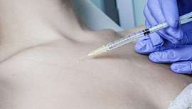 Este novedoso tratamiento intradérmico lleva en su formulación ácido hialurónico de origen sintético y biodegradable