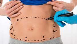 Un estudio publicado por American Society of Plastic Surgeons  (ASPS) demuestra que la abdominoplastia va mucho más allá de un vientre plano, incidiendo positivamente en una menor incontinencia y mejorando los dolores de la espalda 