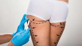 Según un estudio de la Sociedad Catalana de Cirugía Plástica, algunos errores y la tendencia a la naturalidad hacen que nada más y nada menos un 20 por ciento de pacientes pasen por quirófano para arreglar los resultados de otras cirugías