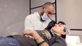 Entre as suas vantagens: rápida cicatrização, inexistência de vermelhidão posterior ou estruturas atróficas e a fácil eliminação da tatuagem