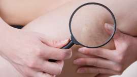 Este nuevo método es incluso capaz de acabar con las grandes varices sin cirugía, dolor o hematomas
