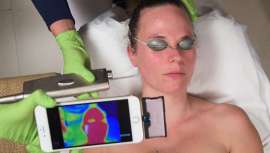 Maribel Yébenes presenta, en exclusiva en la península, este programa, con un láser fraccional con trenes de pulsos largos que rejuvenece la piel hasta su estado óptimo