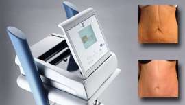 Una nueva herramienta para la regeneración cutánea en Medicina Estética llega a las consultas. Biodermogenesi es una combinación única de tecnologías que ofrece resultados constrastados, rápidos, eficaces e indoloros, en un amplio espectro de casos