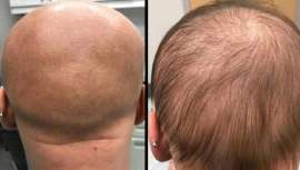 Una adolescente alopécica ha recuperado el pelo tras usar este fármaco contra la dermatitis que contiene dupilumab