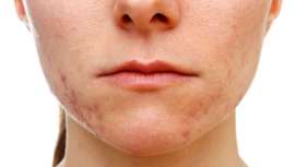 Tecnología de vanguardia que combina aparatología y cápsulas de principios activos, Wishpro elimina cualquier clase de acné, ya sea inflamatorio o no y ofrece los mejores y comprobados resultados 