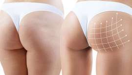 Lo vemos como protagonistas de las figuras más deseadas, el clan Kardashian a la cabeza. El glúteo se convierte en objeto de deseo y reclama las prótesis que lo reconviertan