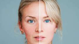 Revisamos con el especialista Dr. López Estebaranz, reconocido dermatólogo, qué es, cómo se produce y agrava y a quién afecta principalmente la rosácea. Una alteración que puede llegar a incapacitar pero contra la cual se puede luchar