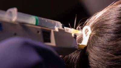 Terapia láser para problemas capilares