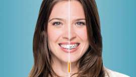 Con más de 450 casos resueltos, el doctor Santamaría, de la Clínica Curull, es speaker de Invisalign® y está certificado por la marca como Platinum Provider