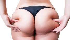 La grasa del siglo XXI no parece ser la misma que la del XX. Entra a escena el lipedema, contenido y definido por la OMS. Instituto Médico Láser nos relata sus clases, tipos, causas y consecuencias y propone su erradicación por medio de lipoláser