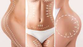 Marina Rulló, directora de los centros de estética Rame, explica este tratamiento, que puede combinarse con ejercicio regular y una buena alimentación para lucir cuerpazo este verano