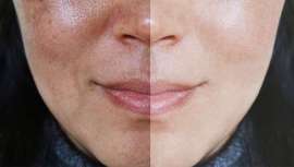 Los pacientes afectados se suelen sentir muy incómodos debido a la rojez del rostro, que en ocasiones es muy acentuada y que socialmente les incomoda