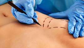 Rejuvenecimiento de cuello mediante láser fraccionado