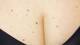 Qué son esos puntos rojos o puntos rubí, por qué aparecen y cómo se tratan. Revisamos las últimas novedades en tratamientos de los puntos rubí con láser vascular, tratamientos naturales y cuánto cuestan