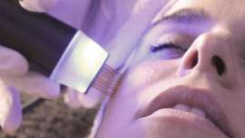 Imperium 400, de Tormamed, dispone del manípulo de Corona Fraccionada Pulsada (CPF) que consigue una actuación y resultados marcadamente mejores con respecto al uso de otras técnicas como el microneedling, rodamiento con agujas o láser fraccionado