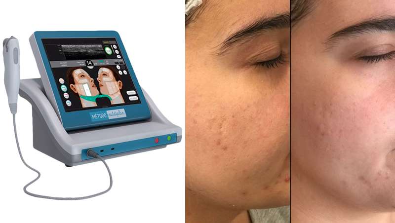 Los mejores resultados faciales con HIFU, el tratamiento ms rentable para tu centro