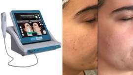 Estetiplan presenta su nueva versión de su equipo estrella Aristo2020 (HIFU), con el que tus clientes y tú conseguiréis  los mejores y más espectaculares resultados, sin que, además, ni tu centro ni tú tengáis que invertir en el equipo