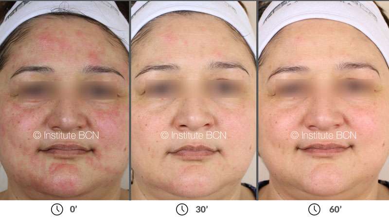 Cómo recuperar la piel después del microneedling en menos de una hora