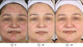 BCN Heal repara y restaura la función barrera de la piel, oxigena y alisa la superficie cutánea, ayuda a mantener los efectos del tratamiento profesional y deja la piel preparada para una nueva sesión de tratamiento