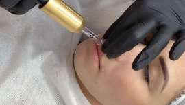 La SEME denuncia ante la AEMPS la venta de nuevos formatos de ácido hialurónico, como HialuroPen, que pueden poner en peligro a los pacientes y recuerda la importancia de acudir a una consulta médica para tratamientos con productos inyectables