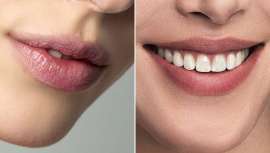 La colección LipUnique de Teoxane, compuesta por una gama de cinco rellenos dérmicos, permite diseñar a medida los labios perfectos. Lo descubrimos paso a paso con los mejores expertos