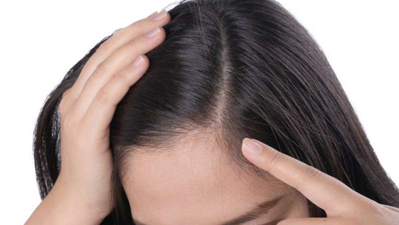 El 20% de las mujeres padece alopecia y el problema puede comenzar en la adolescencia