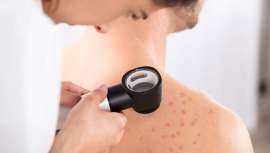 Objetivo: colaborar al mejor conocimiento de la infección por SARS-CoV-2 y sus manifestaciones clínicas, una iniciativa apoyada por la Agencia Española del Medicamento y la asesoría de la Fundación Piel Sana de la AEDV