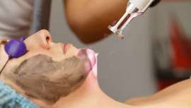 Clinic Medical presenta un tratamiento a base de carbono que se completa con la aplicación de láser Q-Switch Nd: YAG, recomendado contra el acné, cicatrices o la reducción de poros, entre otros resultados 