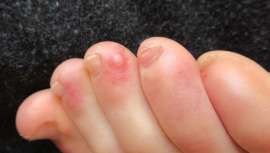 Los problemas dermatológicos a causa del Covid-19 están siendo estudiados a través de las consultas de los propios afectados, contagiados o personas que conviven con alguien afectado por coronavirus