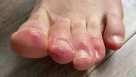 Una vez detectadas algunas alteraciones dermatológicas provocadas por la Covid-19, la AAD, Academia Estadounidense de Dermatología, apunta a la hinchazón y enrojecimiento de los dedos de los pies como posible síntoma de la infección