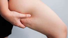 Con esta técnica, se reducen los acúmulos adiposos (celulitis) y la apariencia de la piel mejora notablemente, se vuelve más tersa, rejuvenecida y lista para disimular las estrías