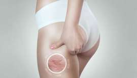 Facialista y nutricionista, Biri Murias tiene todos los secretos de acción conjunta para acabar con la engorrosa e irritante piel de naranja