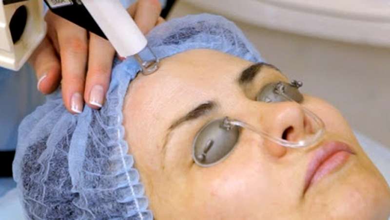 Recosma, el lser fro que superrejuvenece