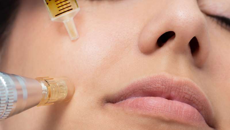 Mesoterapia facial, el tratamiento de Beauty and Care para revitalizar la  piel