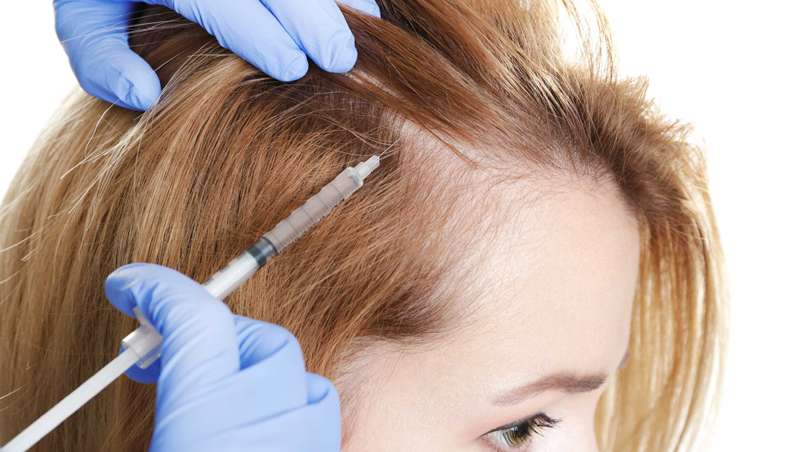 Los beneficios del Plasma Rico en Plaquetas en el cabello