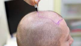 Óscar Mendoza, CEO de MC360, nos da las claves, en este artículo de opinión, sobre la medicina capilar española, un sector en continua expansión y lugar estratégico para este tipo de intervenciones