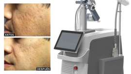 Combinación de CO2 fraccionado y radiofrecuencia para el tratamiento dermatológico de todas las afecciones de la piel 