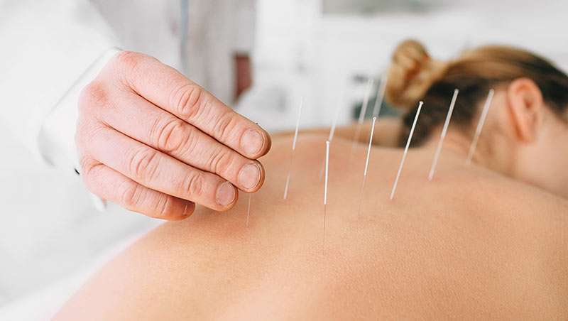 acupuntura en espalda de mujer