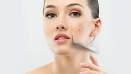 Súmate al Open Masterclass de Lamdors con el que descubrir cómo tratar y corregir el antiestético acné en la cabina con resultados extraordinarios. Asistencia gratuita para profesionales previa admisión. Formato on-line