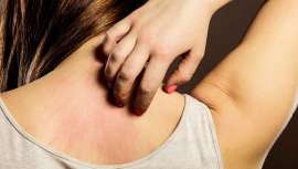 Se analiza la evidencia científica de la interacción entre genes y medio ambiente en el desarrollo de dermatitis atópica con el fin de influir en la toma de desicisiones del estilo de vida y la salud pública